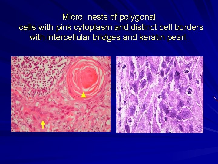 Micro: nests of polygonal cells with pink cytoplasm and distinct cell borders with intercellular