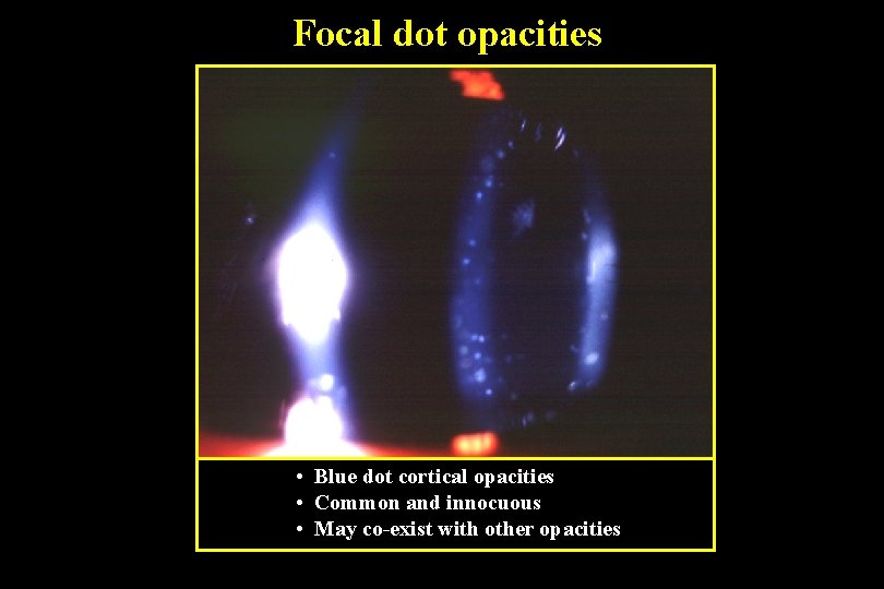 Focal dot opacities • Blue dot cortical opacities • Common and innocuous • May