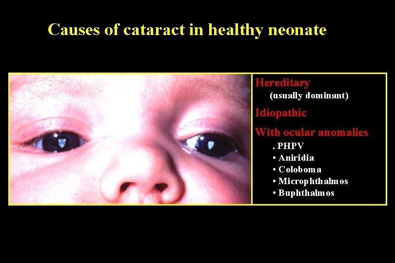 Causes of cataract in healthy neonate Hereditary (usually dominant) Idiopathic With ocular anomalies. PHPV