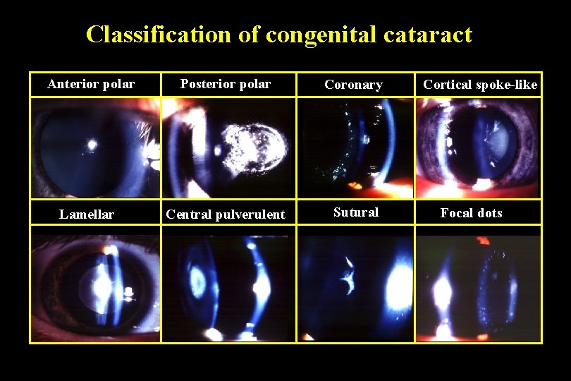 Classification of congenital cataract Anterior polar Posterior polar Coronary Lamellar Central pulverulent Sutural Cortical