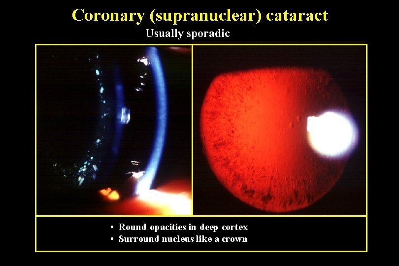 Coronary (supranuclear) cataract Usually sporadic • Round opacities in deep cortex • Surround nucleus