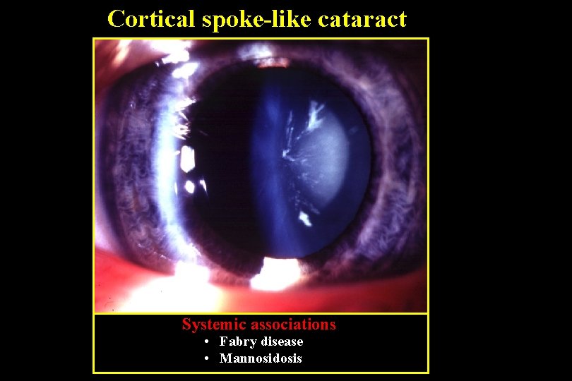 Cortical spoke-like cataract Systemic associations • Fabry disease • Mannosidosis 