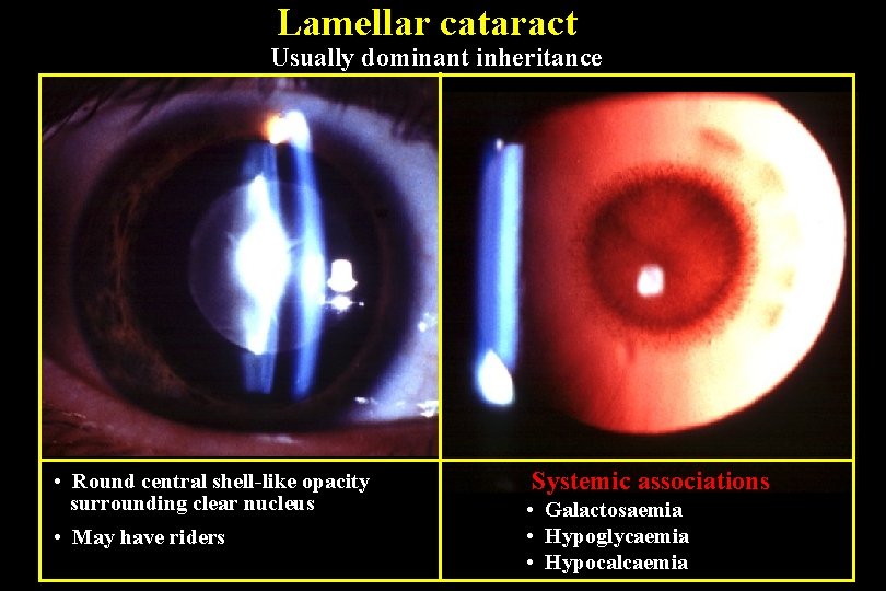 Lamellar cataract Usually dominant inheritance • Round central shell-like opacity surrounding clear nucleus •