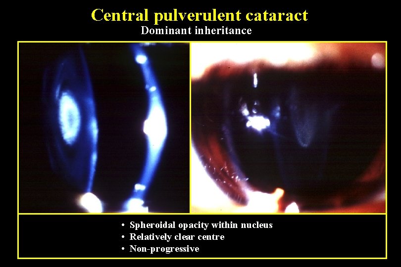 Central pulverulent cataract Dominant inheritance • Spheroidal opacity within nucleus • Relatively clear centre