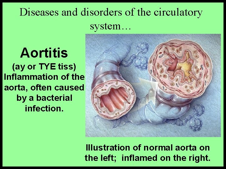Diseases and disorders of the circulatory system… Aortitis (ay or TYE tiss) Inflammation of Diseases and disorders of the circulatory system… Aortitis (ay or TYE tiss) Inflammation of