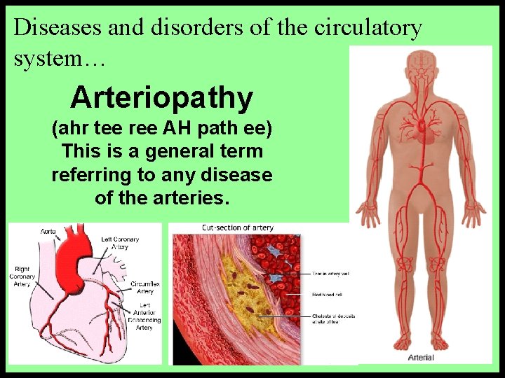Diseases and disorders of the circulatory system… Arteriopathy (ahr tee ree AH path ee) Diseases and disorders of the circulatory system… Arteriopathy (ahr tee ree AH path ee)