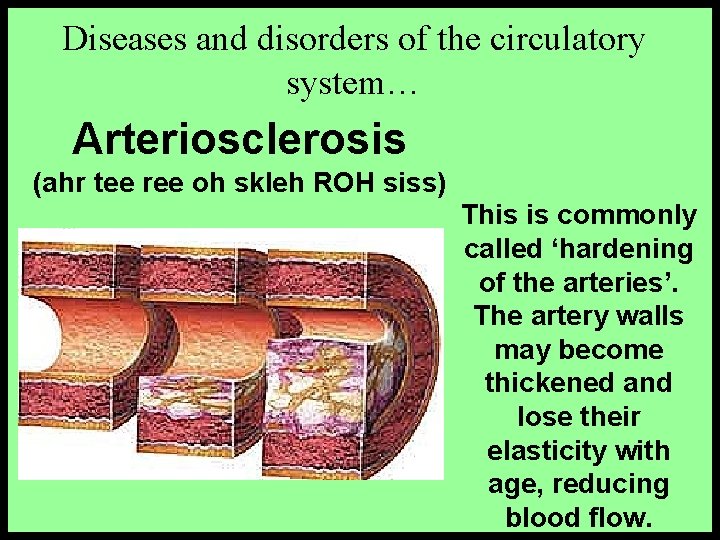Diseases and disorders of the circulatory system… Arteriosclerosis (ahr tee ree oh skleh ROH Diseases and disorders of the circulatory system… Arteriosclerosis (ahr tee ree oh skleh ROH