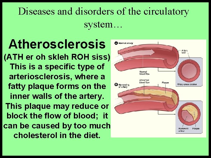 Diseases and disorders of the circulatory system… Atherosclerosis (ATH er oh skleh ROH siss) Diseases and disorders of the circulatory system… Atherosclerosis (ATH er oh skleh ROH siss)