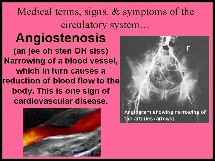 Medical terms, signs, & symptoms of the circulatory system… Angiostenosis (an jee oh sten Medical terms, signs, & symptoms of the circulatory system… Angiostenosis (an jee oh sten
