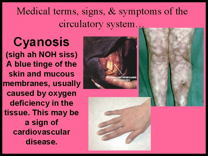 Medical terms, signs, & symptoms of the circulatory system… Cyanosis (sigh ah NOH siss) Medical terms, signs, & symptoms of the circulatory system… Cyanosis (sigh ah NOH siss)