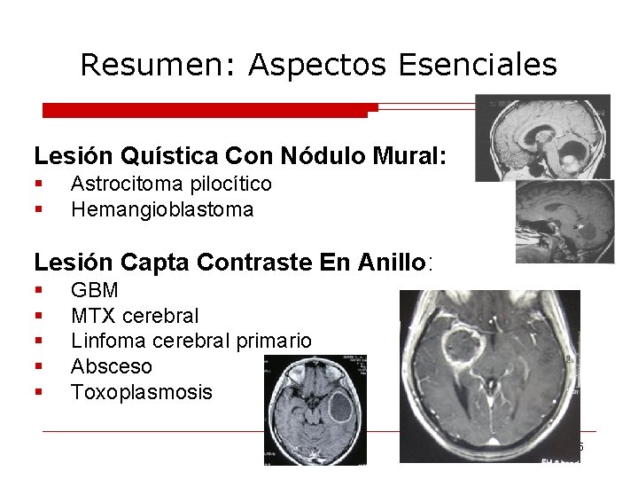 Resumen: Aspectos Esenciales Lesión Quística Con Nódulo Mural: § § Astrocitoma pilocítico Hemangioblastoma Lesión