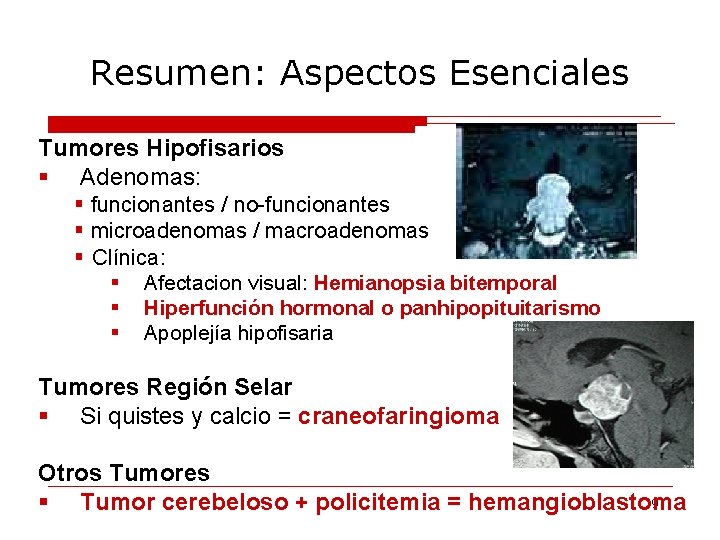 Resumen: Aspectos Esenciales Tumores Hipofisarios § Adenomas: § funcionantes / no-funcionantes § microadenomas /