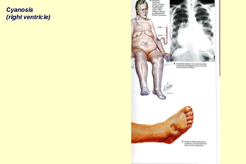 Cyanosis (right ventricle) 