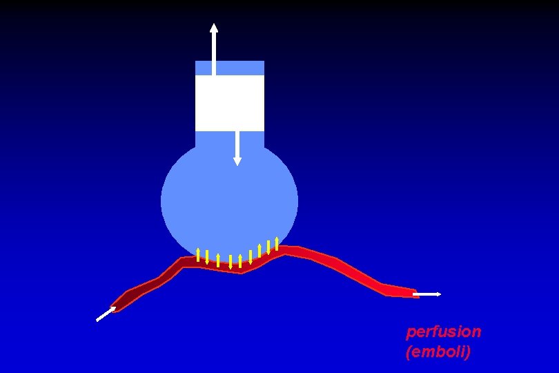 perfusion (emboli) 