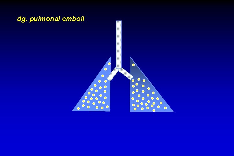 dg. pulmonal emboli 