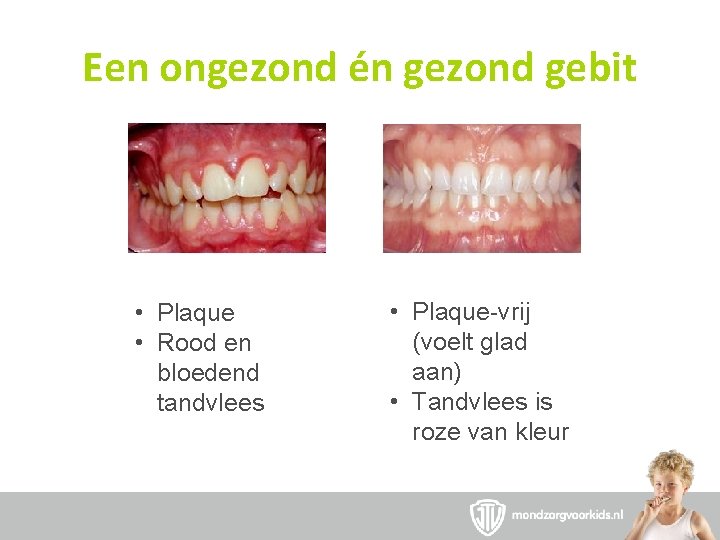 Een ongezond én gezond gebit • Plaque • Rood en bloedend tandvlees • Plaque-vrij