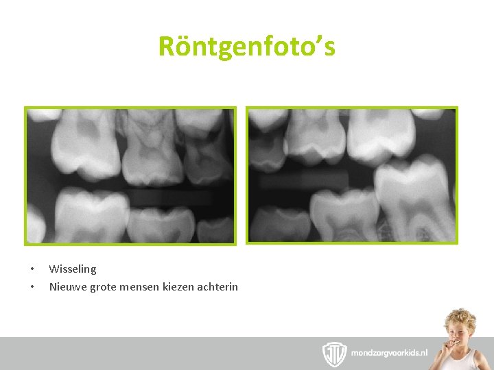 Röntgenfoto’s • • Wisseling Nieuwe grote mensen kiezen achterin 