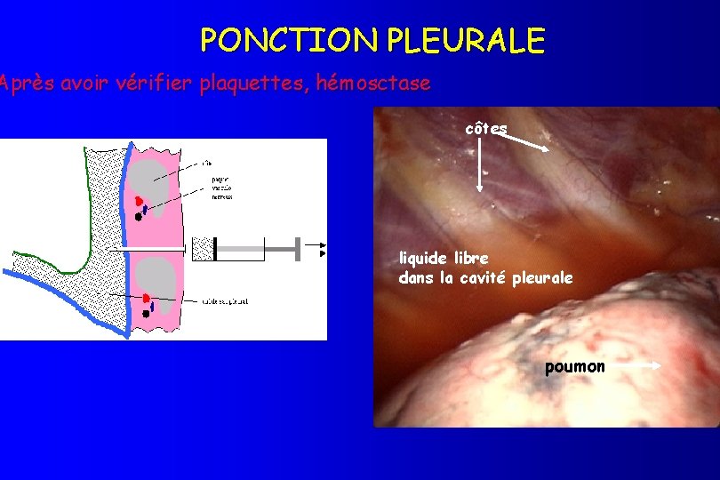 PONCTION PLEURALE Après avoir vérifier plaquettes, hémosctase côtes liquide libre dans la cavité pleurale