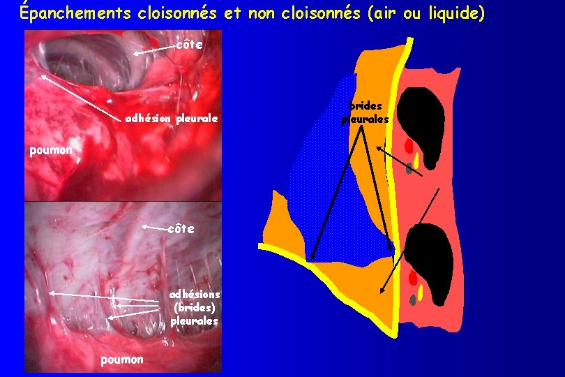 Épanchements cloisonnés et non cloisonnés (air ou liquide) côte adhésion pleurale poumon côte adhésions