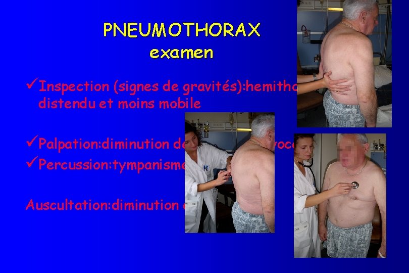 PNEUMOTHORAX examen üInspection (signes de gravités): hemithorax plus distendu et moins mobile üPalpation: diminution