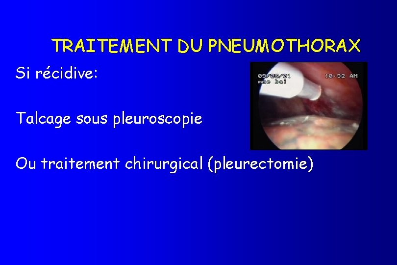 TRAITEMENT DU PNEUMOTHORAX Si récidive: Talcage sous pleuroscopie Ou traitement chirurgical (pleurectomie) 