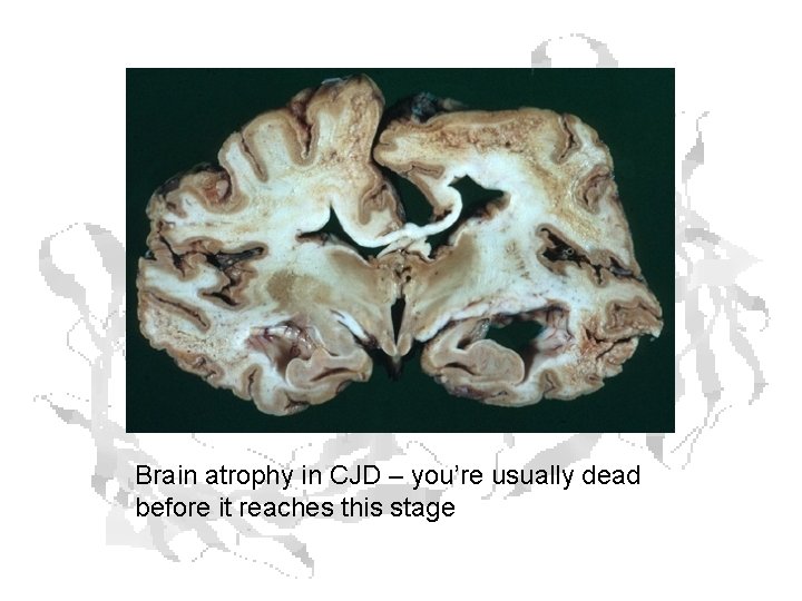 Brain atrophy in CJD – you’re usually dead before it reaches this stage 