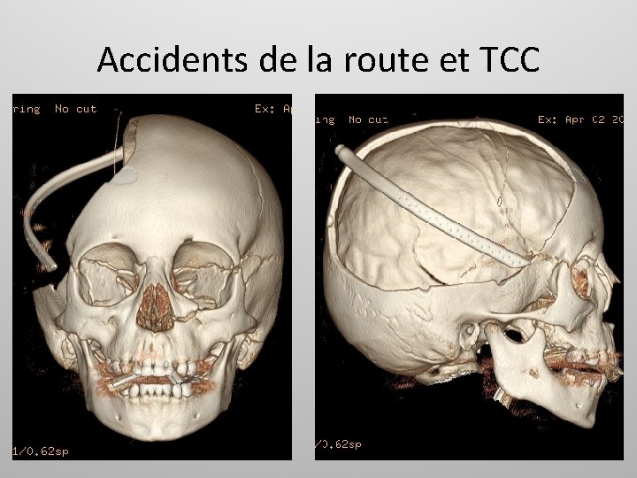 Accidents de la route et TCC 