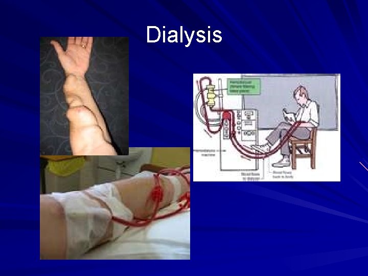 Dialysis 