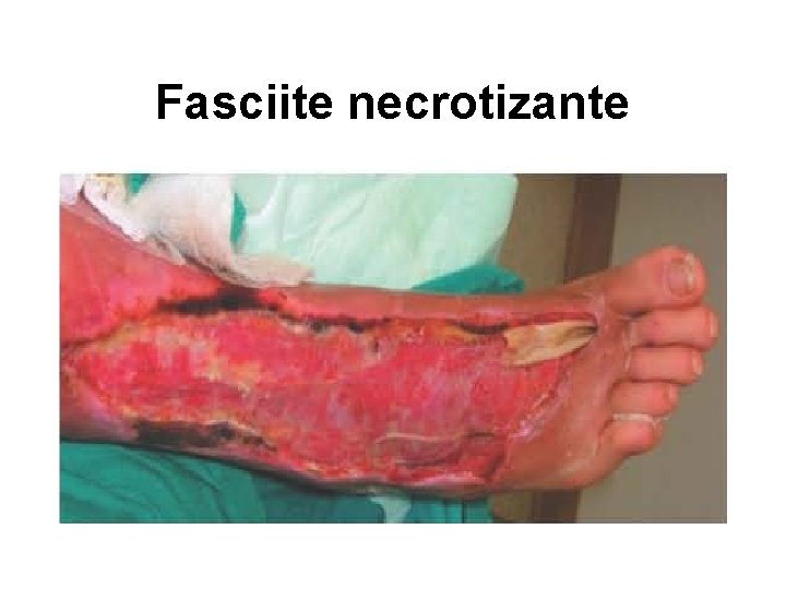 Fasciite necrotizante 