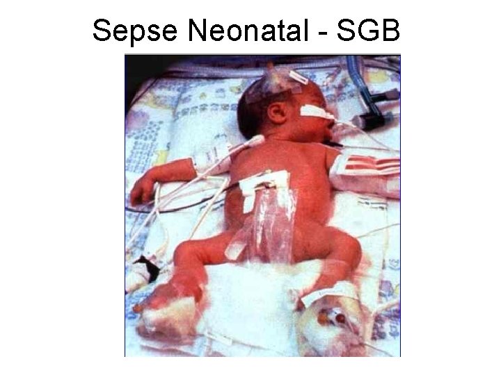 Sepse Neonatal - SGB 