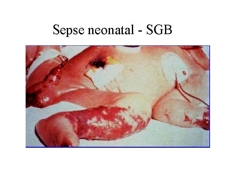 Sepse neonatal - SGB 