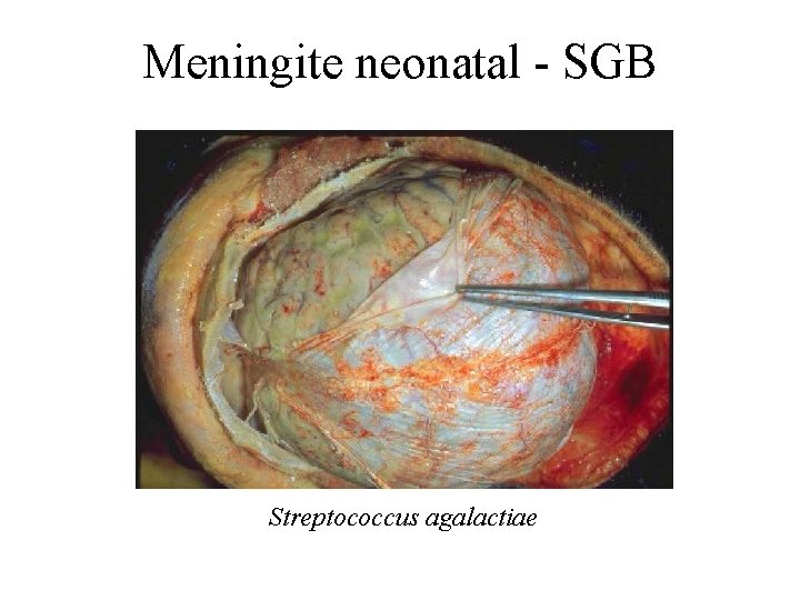 Meningite neonatal - SGB Streptococcus agalactiae 