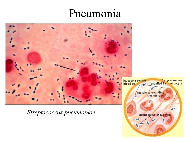 Pneumonia Streptococcus pneumoniae 