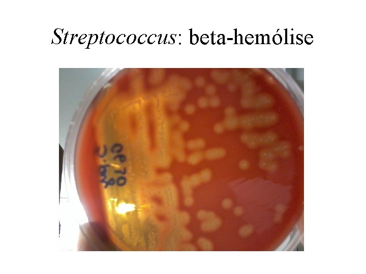 Streptococcus: beta-hemólise 