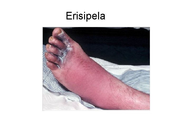 Erisipela 