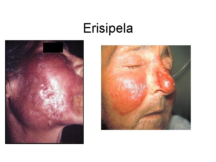 Erisipela 