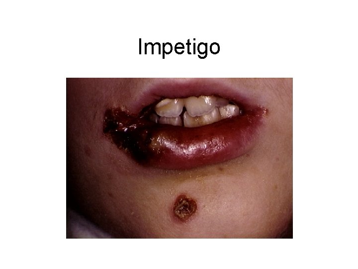 Impetigo 