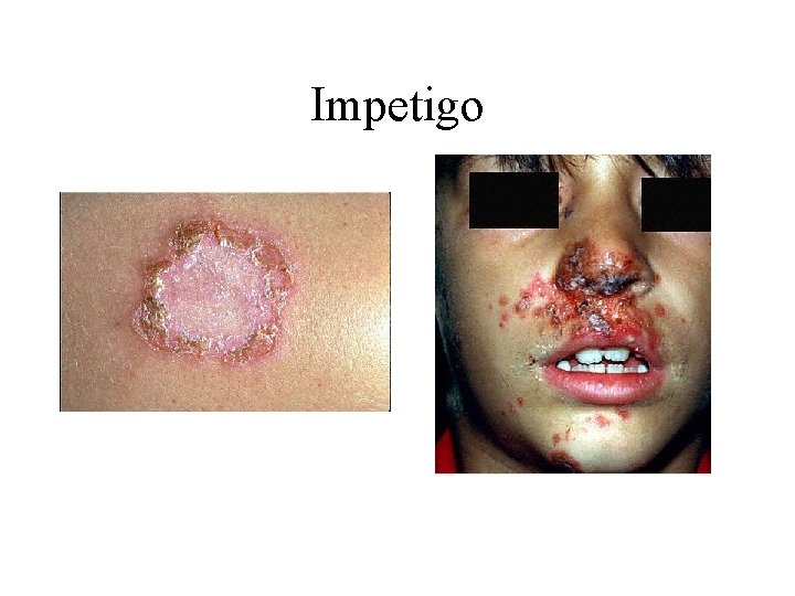 Impetigo 