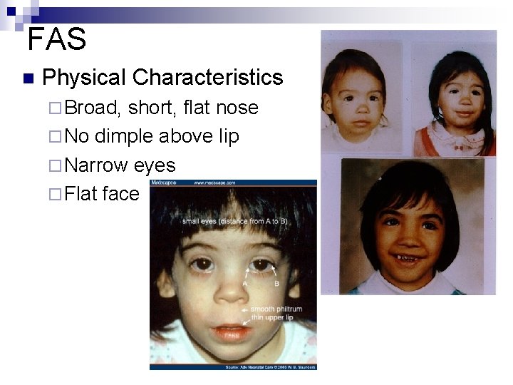 FAS n Physical Characteristics ¨ Broad, short, flat nose ¨ No dimple above lip