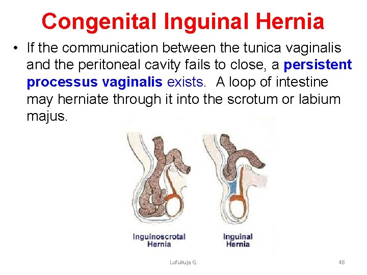 Congenital Inguinal Hernia • If the communication between the tunica vaginalis and the peritoneal
