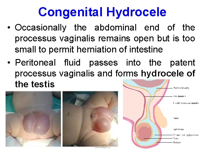 Congenital Hydrocele • Occasionally the abdominal end of the processus vaginalis remains open but