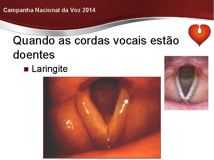 Campanha Nacional da Voz 2014 Quando as cordas vocais estão doentes Laringite 