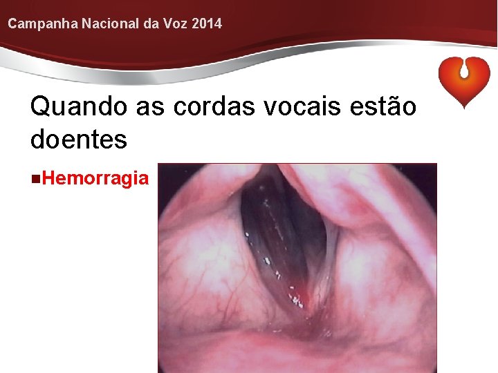 Campanha Nacional da Voz 2014 Quando as cordas vocais estão doentes Hemorragia 