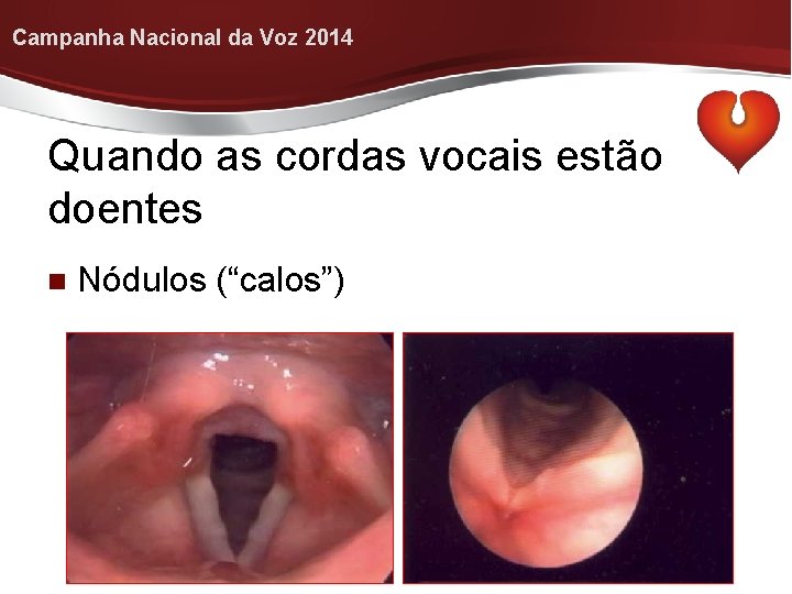 Campanha Nacional da Voz 2014 Quando as cordas vocais estão doentes Nódulos (“calos”) 
