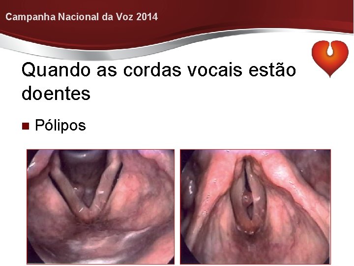 Campanha Nacional da Voz 2014 Quando as cordas vocais estão doentes Pólipos 