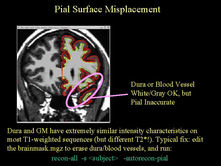 Pial Surface Misplacement Dura or Blood Vessel White/Gray OK, but Pial Inaccurate Dura and