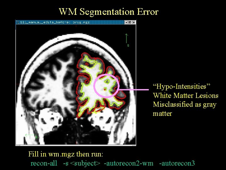 WM Segmentation Error “Hypo-Intensities” White Matter Lesions Misclassified as gray matter Fill in wm.