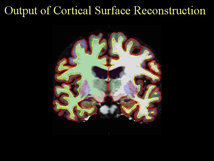 Output of Cortical Surface Reconstruction 