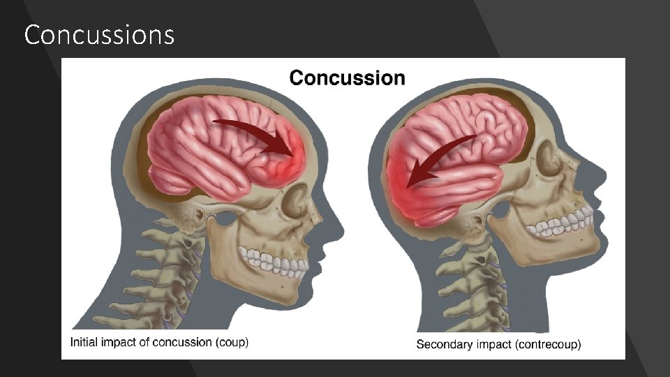 Concussions 