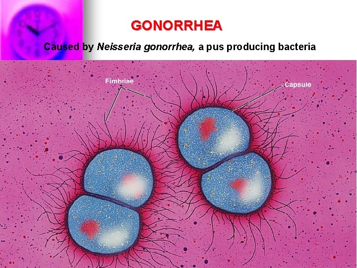 GONORRHEA Caused by Neisseria gonorrhea, a pus producing bacteria Up to 1 MILLION people GONORRHEA Caused by Neisseria gonorrhea, a pus producing bacteria Up to 1 MILLION people